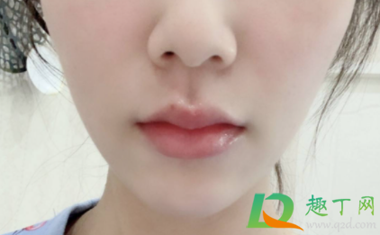 嘴角干裂口缺什么维生素3