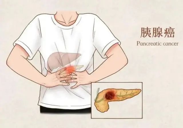 保护胰腺，就是守住生命线，医生：保护胰腺，要从这几件小事做起