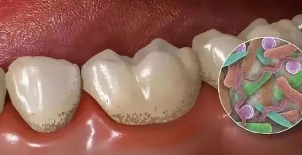 “洗牙”对牙齿有伤害吗？医生：5类人群尽量别洗牙，不要不在意