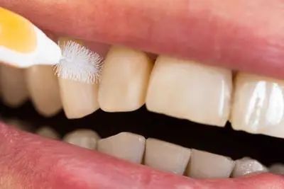 “洗牙”对牙齿有伤害吗？医生：5类人群尽量别洗牙，不要不在意