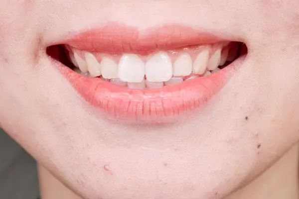 “洗牙”对牙齿有伤害吗？医生：5类人群尽量别洗牙，不要不在意
