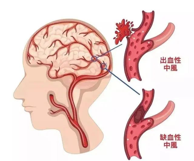 62岁大爷吃氨氯地平，突发脑梗，医生怒斥：降压药不能这么服用