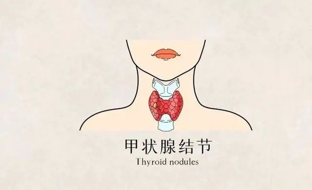 查出结节怎么办？医生：少吃4类“发物”，结节或慢慢缩小