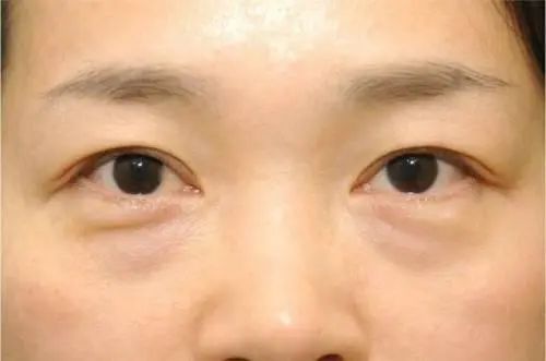 若想稳定血脂，这3种蔬菜尽量少吃，不妨来了解