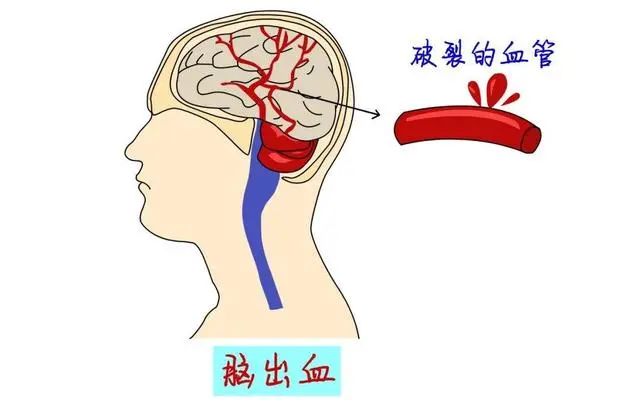 什么是脑溢血！脑溢血来临前，身体有哪些异常？望知晓