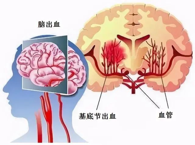 什么是脑溢血！脑溢血来临前，身体有哪些异常？望知晓