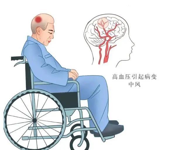 什么是脑溢血！脑溢血来临前，身体有哪些异常？望知晓