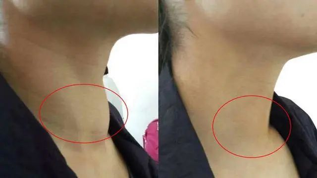 一天一个苹果，真能散结节？医生：苹果搭配2事，结节消散