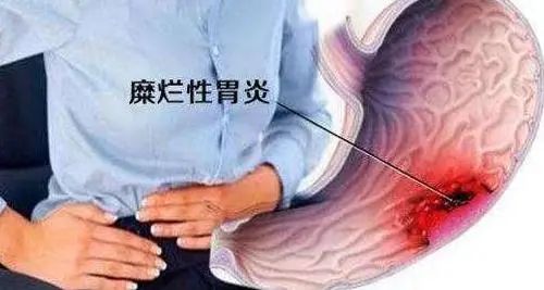 提醒：炎症或致癌症，出现6种炎症别拖，尽早治疗为好