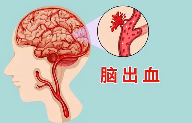 55岁男子血压143/90，满不在乎，结果脑出血！一些错误不该有