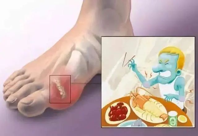 苦瓜能降尿酸吗？医生：这4种食物才是降尿酸能手，平时不妨多吃