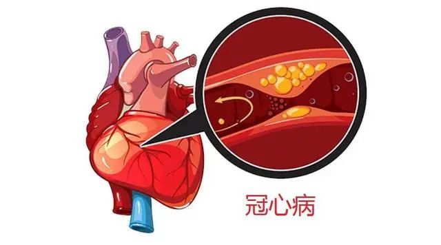 预防冠心病，前提要睡好，医生：调理心血管健康，4个秘诀很重要