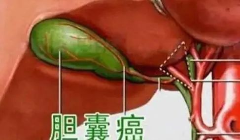 如果切除“胆囊”，会有哪些“后遗症”？或还有人不清楚，望了解