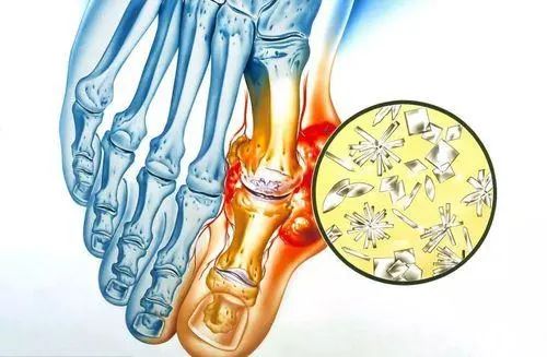 高尿酸的“冤家”或被找到？冬瓜垫底，若你爱吃，或能预防痛风