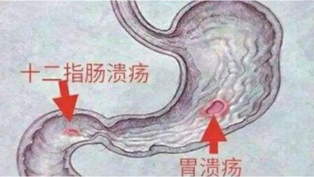 为什么不建议老年人每天吃阿司匹林呢？知情人士说出答案