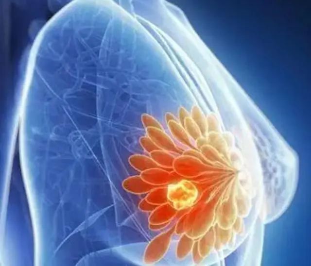 有些女性为什么容易患乳腺癌呢？医生提示：尽量避免这几种行为