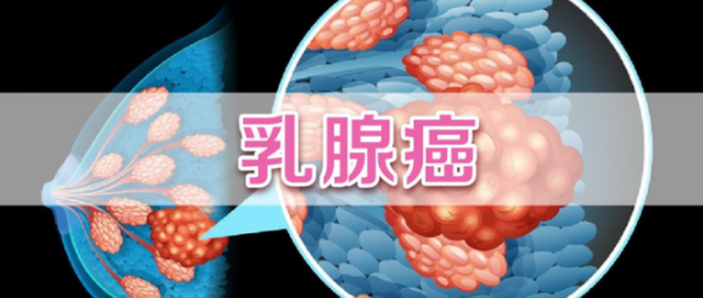 有些女性为什么容易患乳腺癌呢？医生提示：尽量避免这几种行为