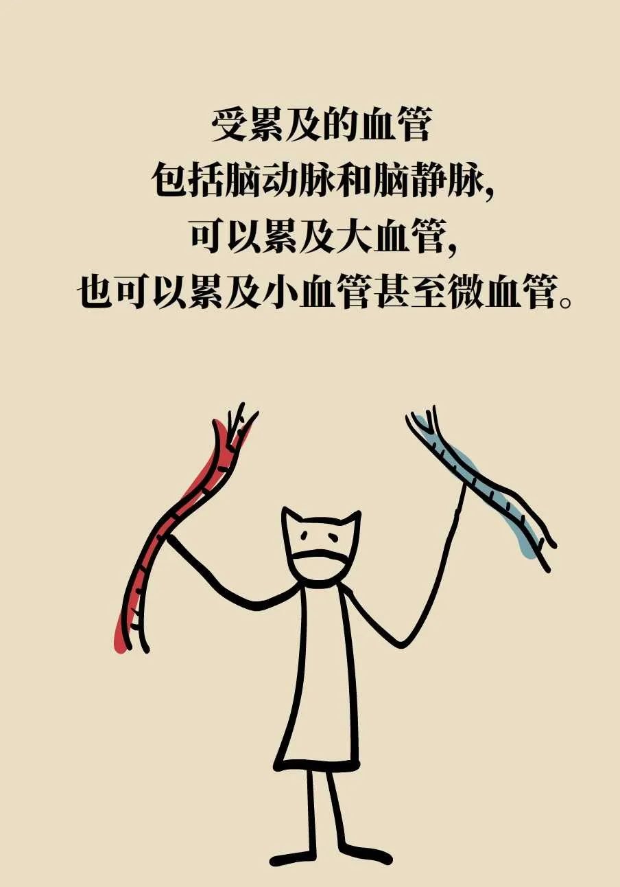 脑梗死、脑出血、脑卒中、脑中风是一回事吗？一文讲清