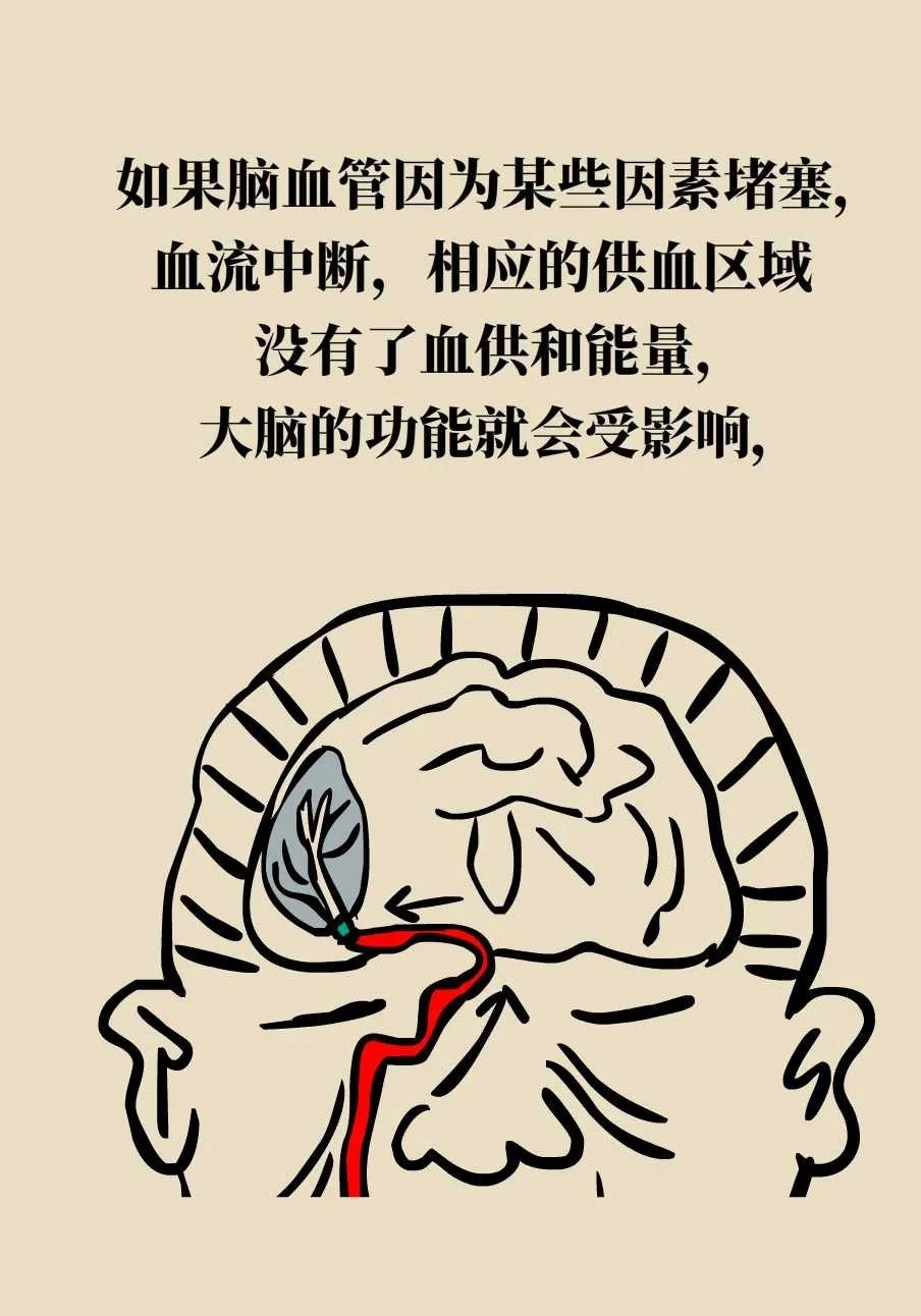脑梗死、脑出血、脑卒中、脑中风是一回事吗？一文讲清