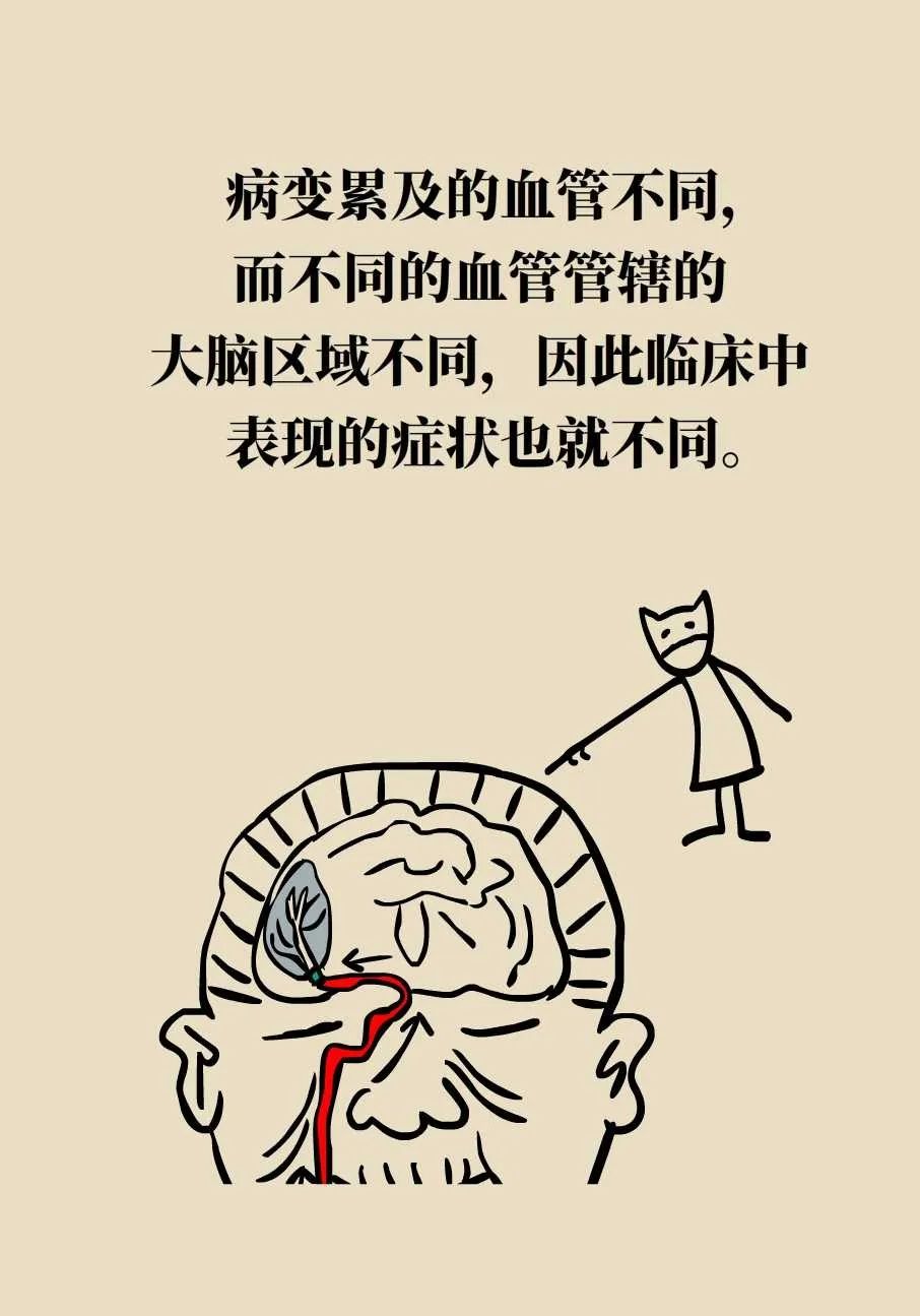 脑梗死、脑出血、脑卒中、脑中风是一回事吗？一文讲清