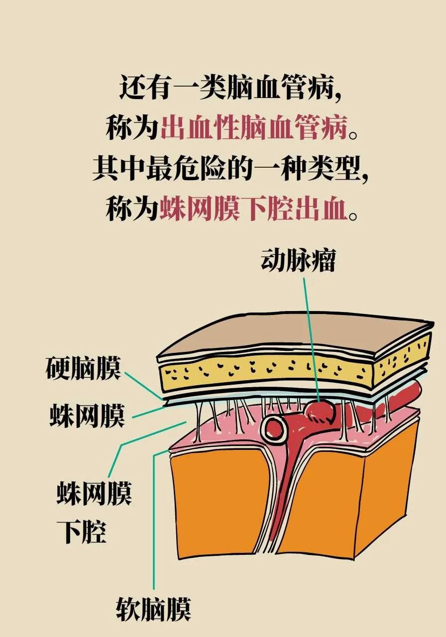 脑梗死、脑出血、脑卒中、脑中风是一回事吗？一文讲清