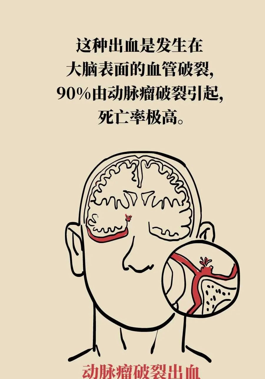 脑梗死、脑出血、脑卒中、脑中风是一回事吗？一文讲清