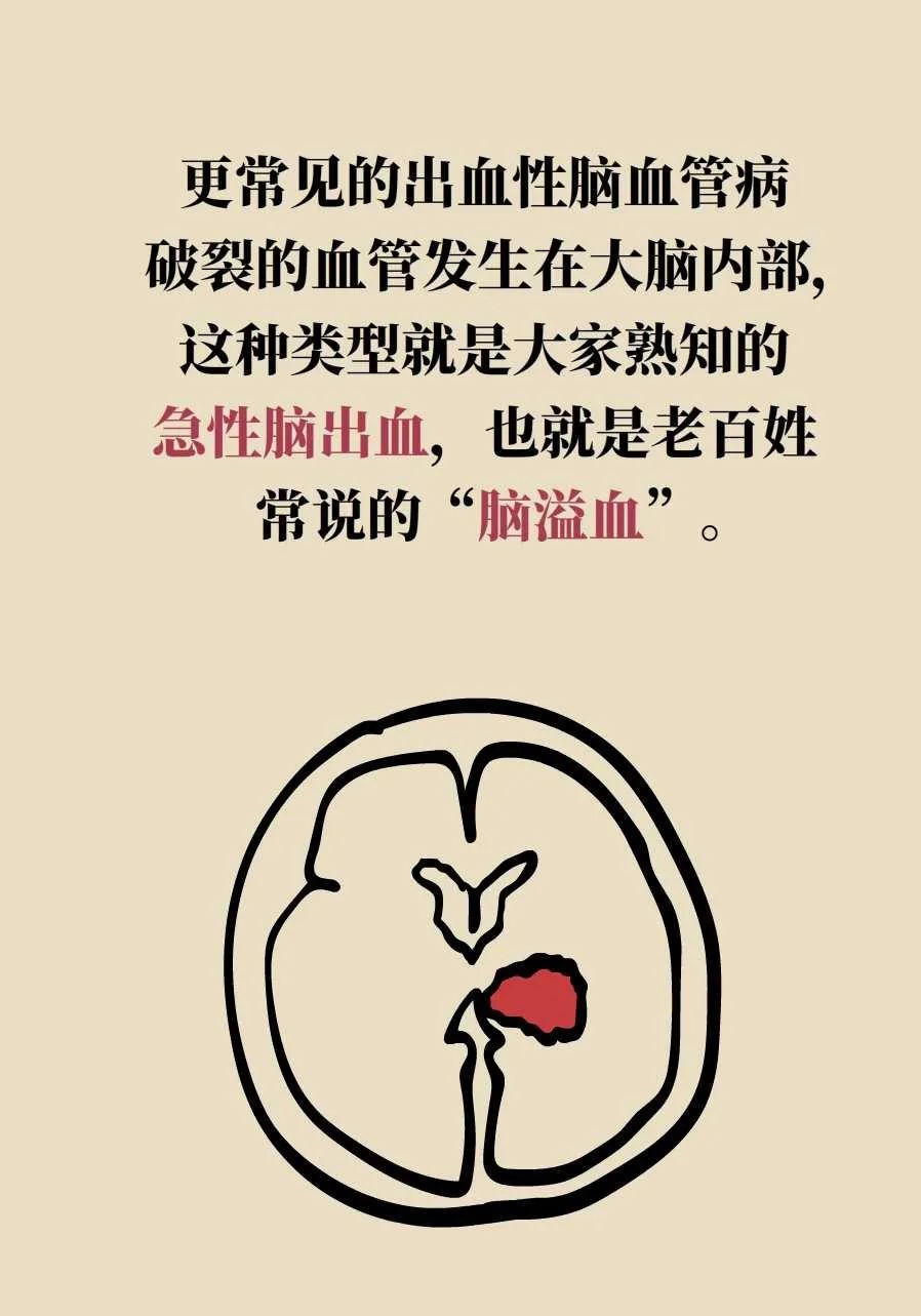 脑梗死、脑出血、脑卒中、脑中风是一回事吗？一文讲清