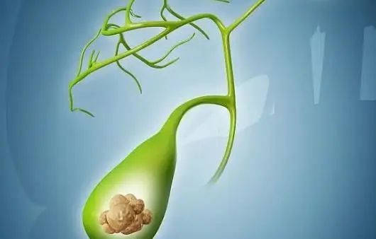 医生提醒：酒后若出现5个症状，或是“胰腺炎”，别不当回事
