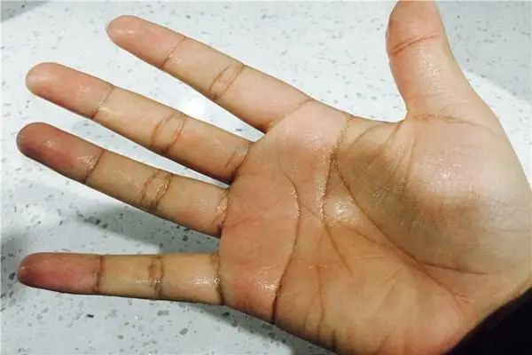 怕热总出汗，是体虚还是在排毒？出汗多和少哪个更健康？
