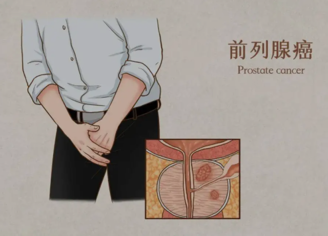 肿瘤界争议：3类癌症或不该称为“癌”，不要过度治疗