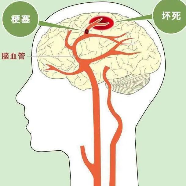 得了脑梗有几率恢复吗？医生说出大实话，大家牢记