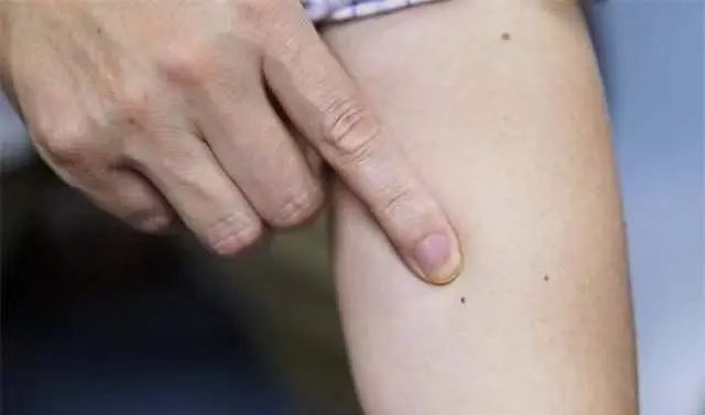 别把艾滋误以为皮肤病？身体若出现5种症状时，或要及早检查