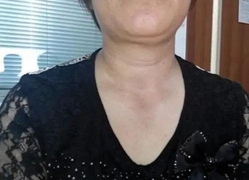 为何中国甲状腺癌人数突然“飙升”呢？医学专家说出大实话