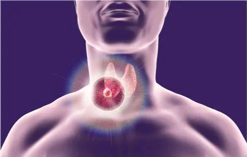 为何中国甲状腺癌人数突然“飙升”呢？医学专家说出大实话