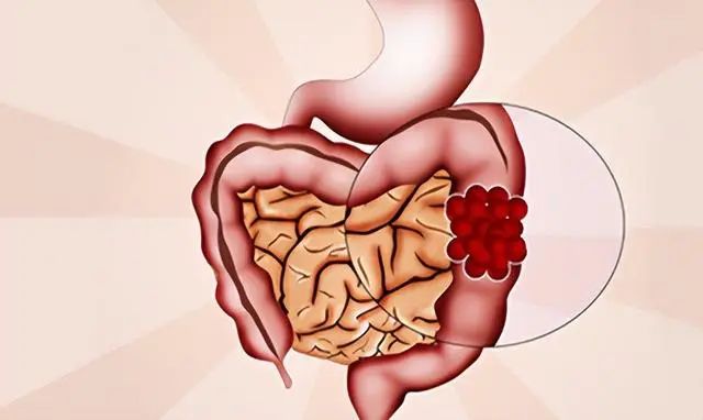 肠癌就是傻子癌？医生：身体出现这些症状要及早治疗