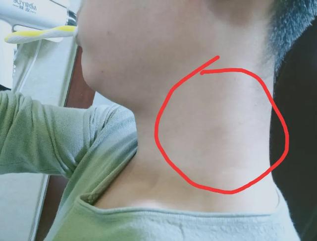 体内有癌，脖子会知？医生提醒：脖子上若出现3种异样，尽早检查