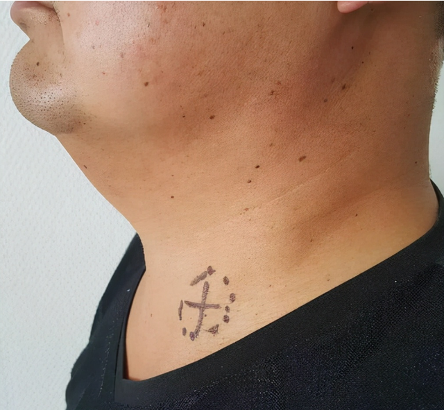 体内有癌，脖子会知？医生提醒：脖子上若出现3种异样，尽早检查