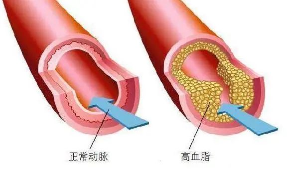 蹲一会儿突然站起来，“眼冒金星”，是低血糖吗？不妨了解一下