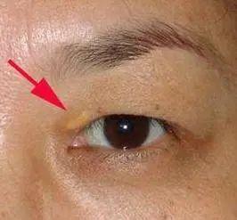 蹲一会儿突然站起来，“眼冒金星”，是低血糖吗？不妨了解一下