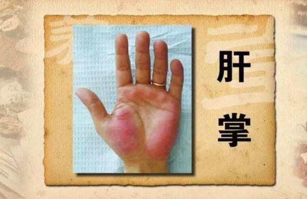 肝不好，是“面条”吃多了？医生：牢记“4喝、4不喝”，对肝好