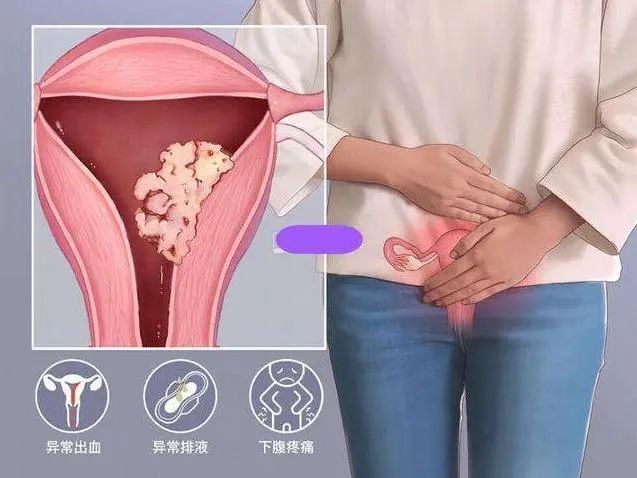 宫颈癌多是“拖”出来的吗？女人身体若有3处异常，建议趁早就医