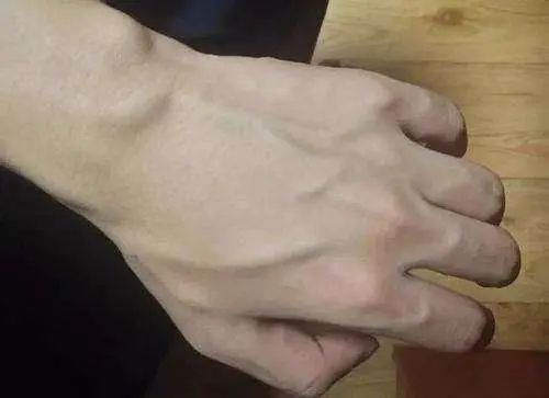 有的人手臂“青筋暴起”，有的人几乎看不到青筋，谁更健康呢？