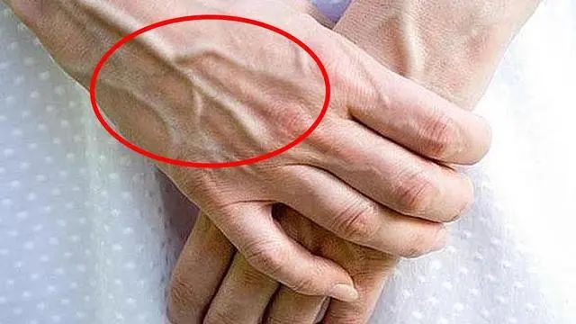 有的人手臂“青筋暴起”，有的人几乎看不到青筋，谁更健康呢？