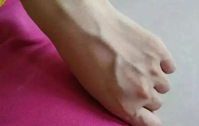 有的人手臂“青筋暴起”，有的人几乎看不到青筋，谁更健康呢？