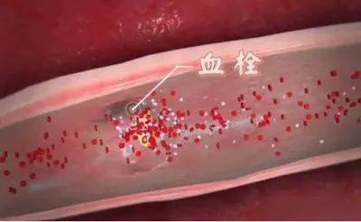 腿是血栓的“报警器”？医生：腿上若有2种情况，或是血栓已形成