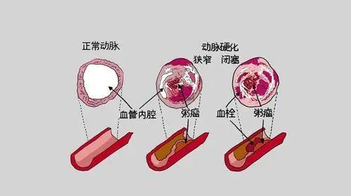 高血脂能吃豆腐吗？医生：6种降脂食物常吃，血脂或会悄悄下降
