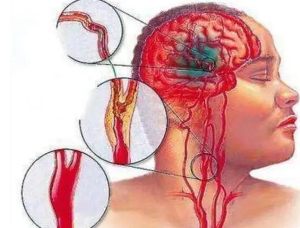 一勺猪油等于五副药？常吃猪油是养生还是有害？一次性告诉您真相
