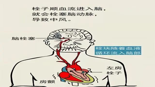 脑梗死越来越多，哈佛大学医学院：坚持做到这3件事，远离脑梗
