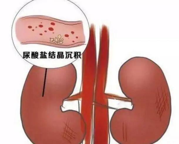 苦瓜可以降尿酸吗？医生：这5物才是降尿酸“高手”，建议吃些