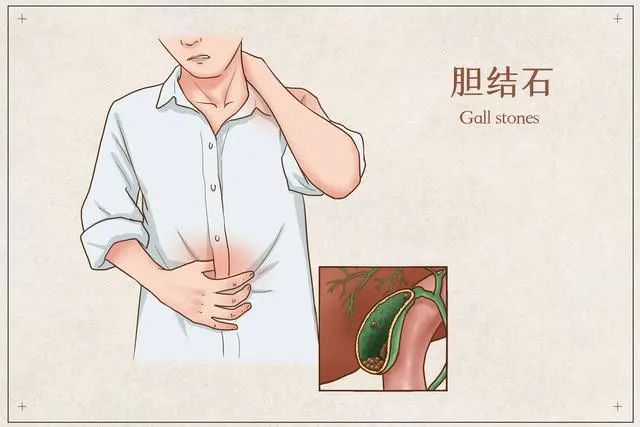 以前都是保胆取石，为啥现在查出胆结石，就要切除胆囊？令人深思